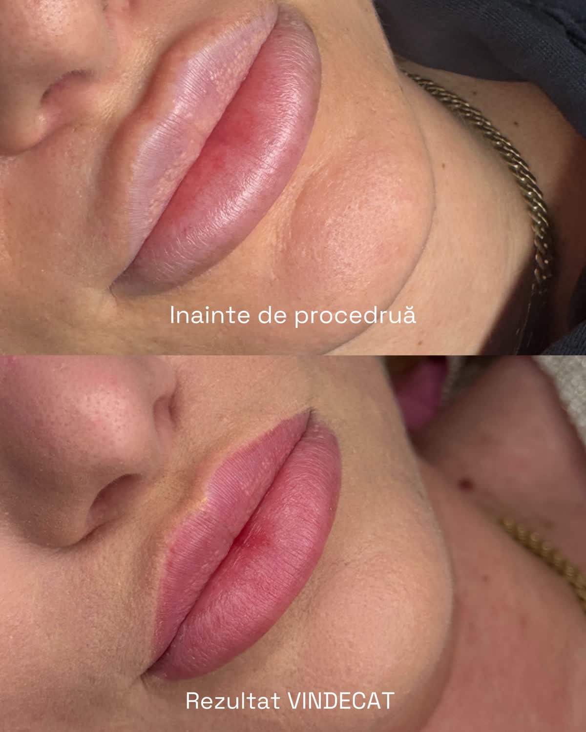 Buze – before after rezultat vindecat